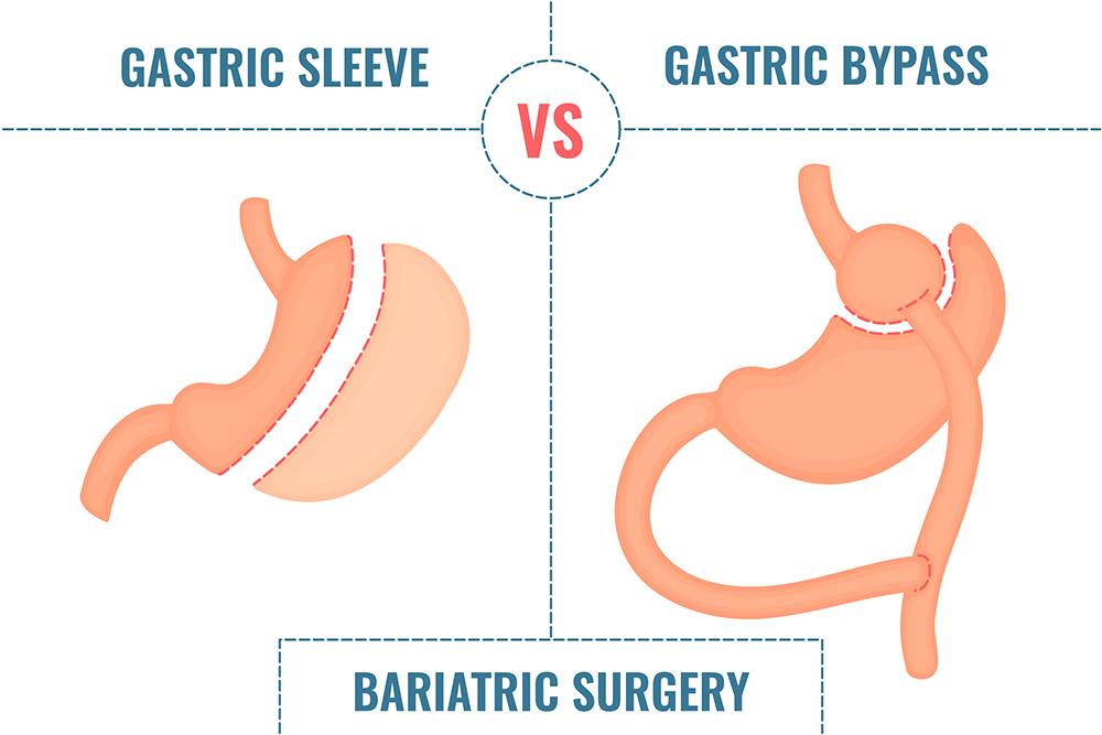 Gastric Bypass Surgery Melbourne | Gastric Bypass Surgery Cost Melbourne | What is Gastric Bypass Surgery