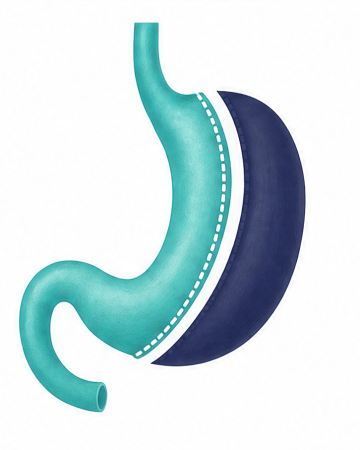 gastric sleeve